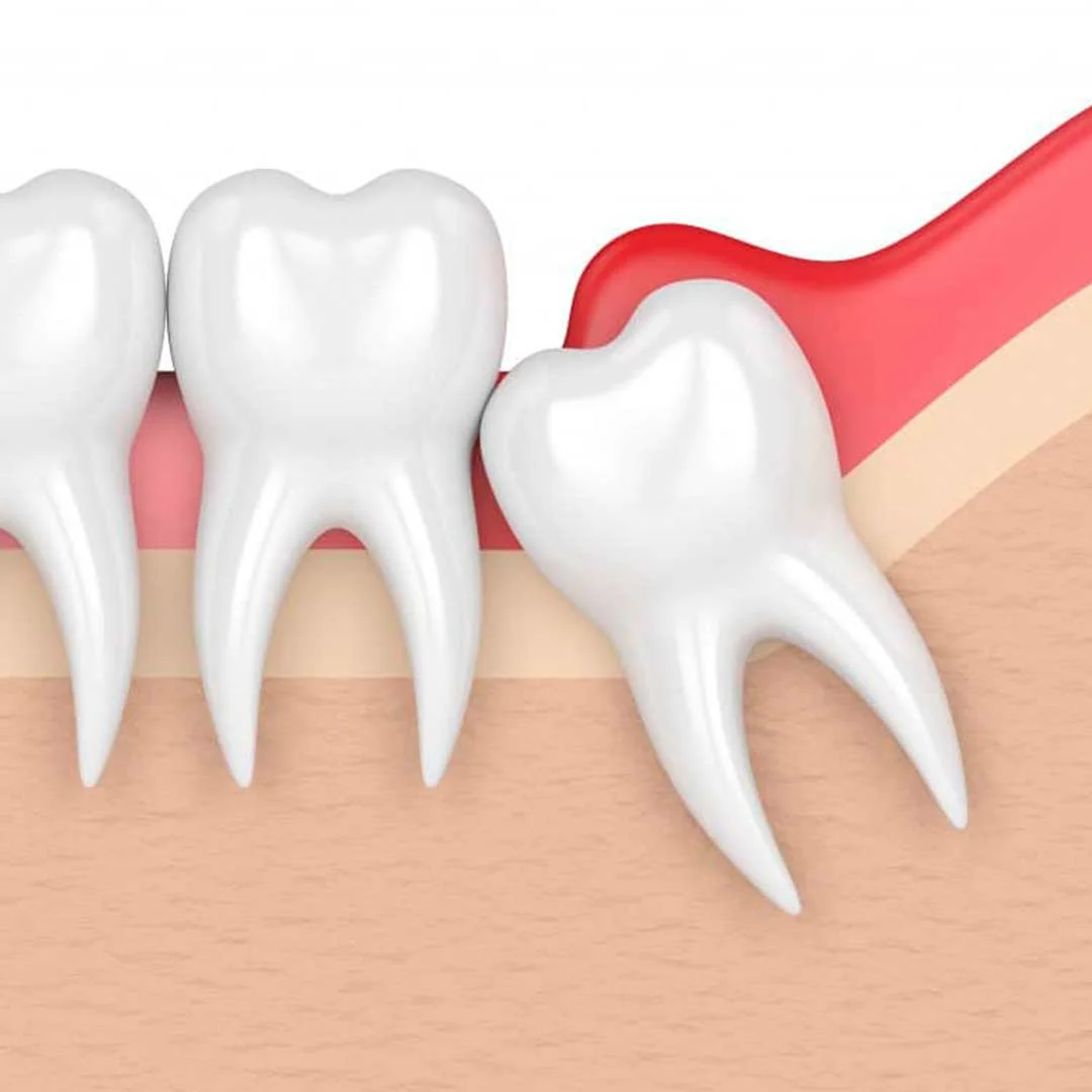 Pericoronitis Treatment