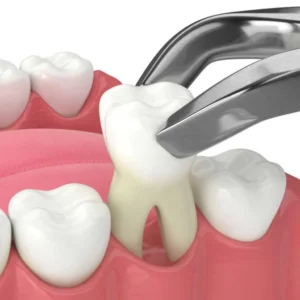 Tooth Extraction 脫牙 灣仔牙醫