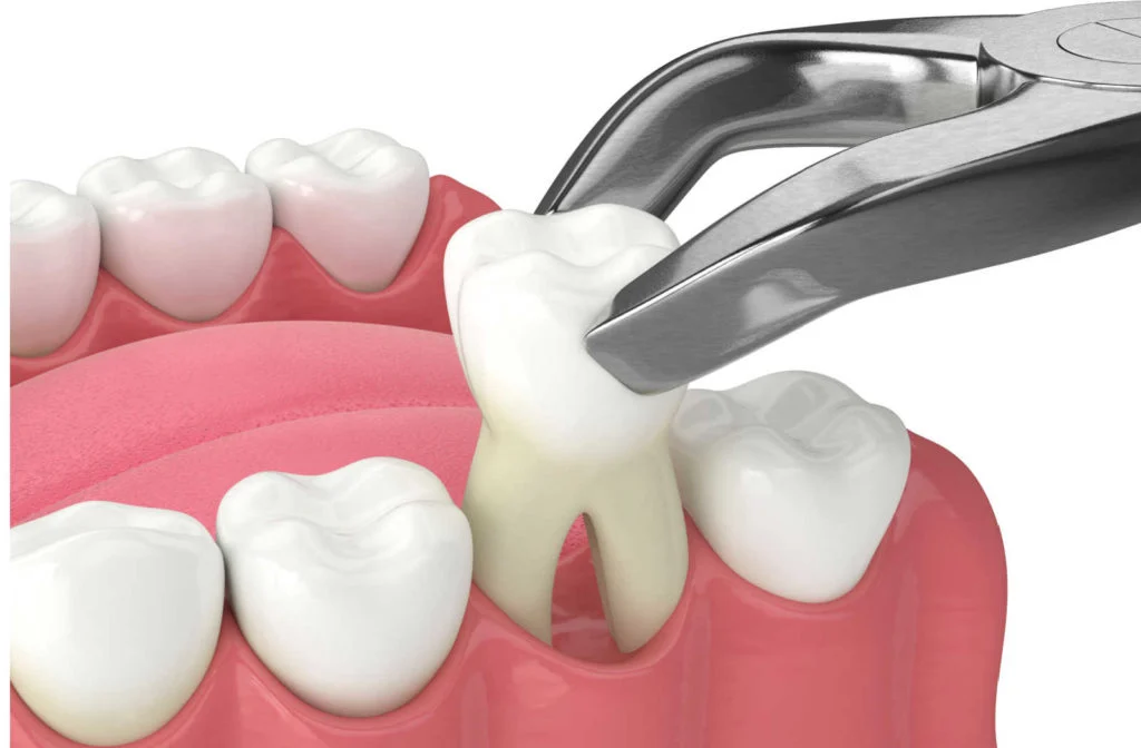 Tooth Extraction