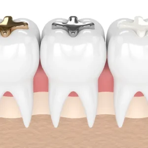 Tooth Filling 補牙 黃大仙牙醫