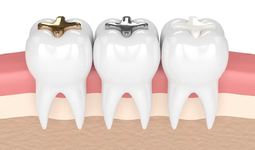 Tooth Filling
