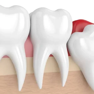 Wisdom Teeth Extraction 天后牙醫