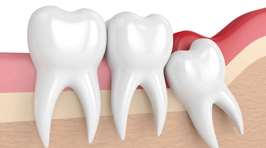 Wisdom Tooth Extraction