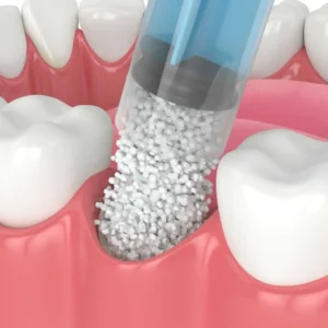 Dental Bone Graft 骨粉 北角牙醫