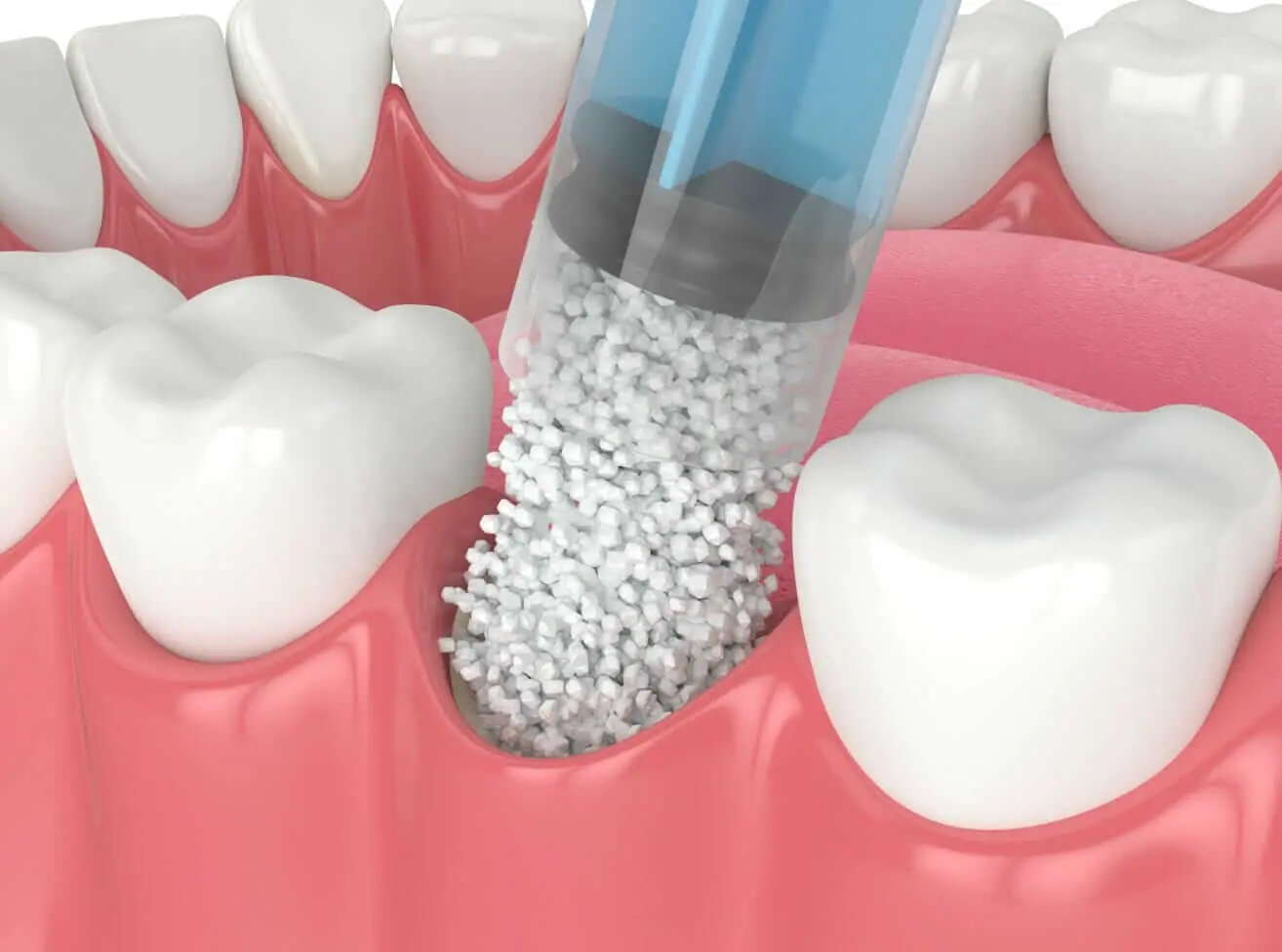 Dental Bone Graft 骨粉 北角牙醫
