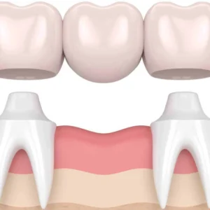 Dental Bridge 東涌牙醫