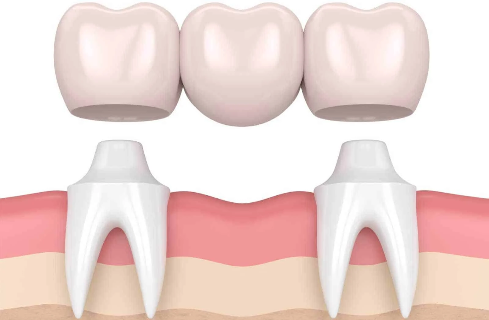 Dental Bridge 東涌牙醫