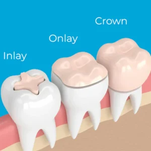 Inlay Onlay 旺角牙醫