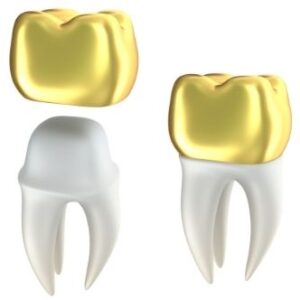 Dental Gold Crown 大學牙醫