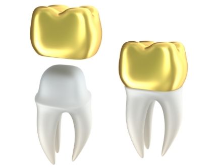 Dental Gold Crown 大學牙醫