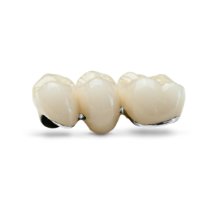 Porcelain Fused to Metal Crown 粉嶺牙醫