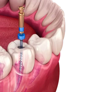 Root Canal Treatment 杜牙根 香港牙醫價錢