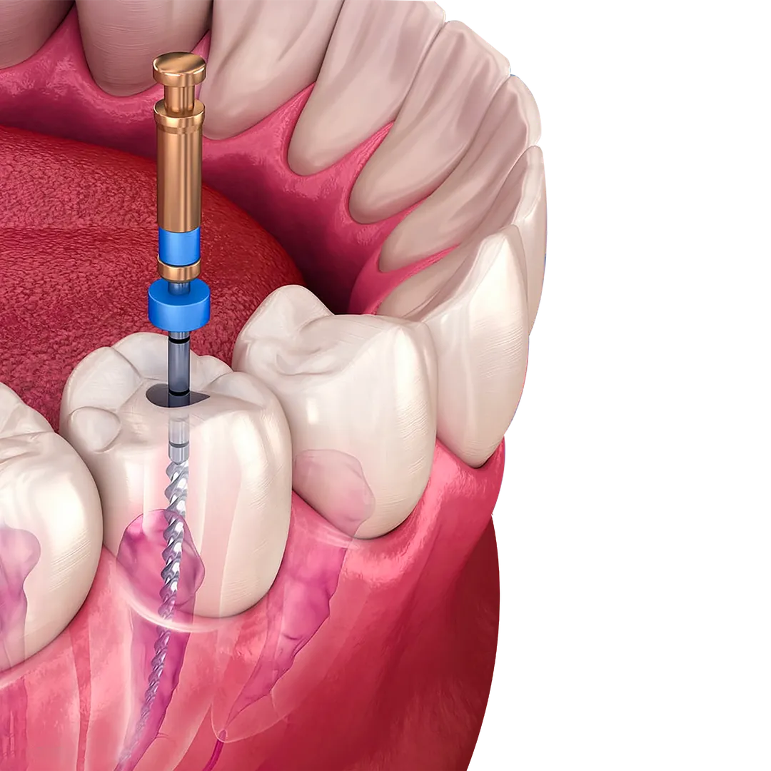 Root Canal