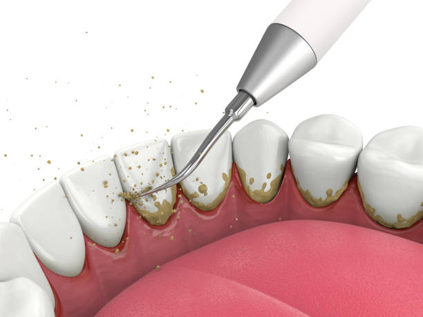 Teeth Ultrasonic Scaling