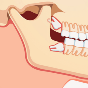 Upper Lower Wisdom Teeth 上環牙醫