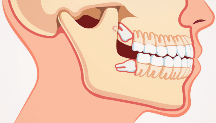 Wisdom Tooth Extraction - Upper Tooth