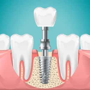 dental implant 沙田牙醫