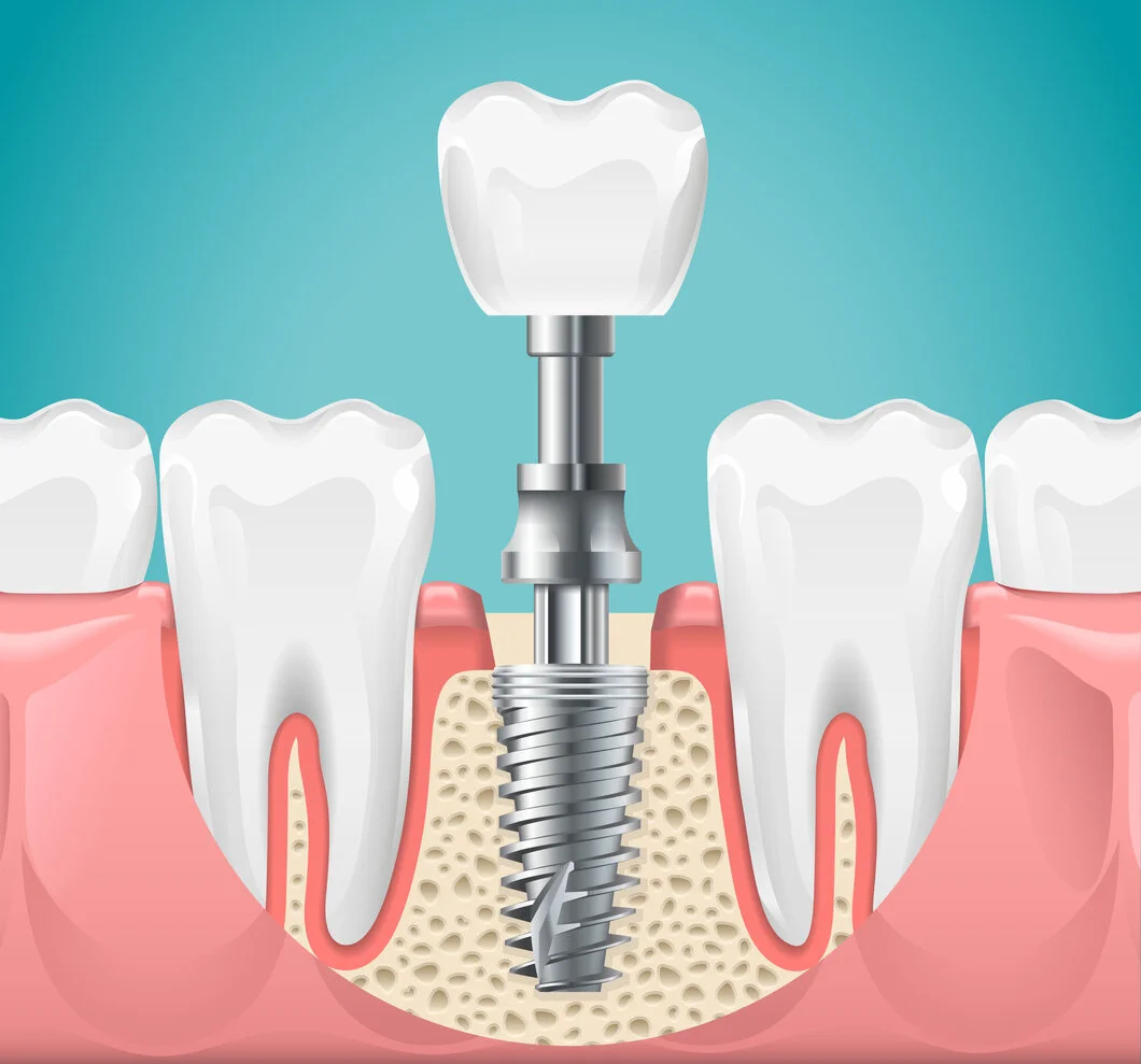 dental implant 沙田牙醫