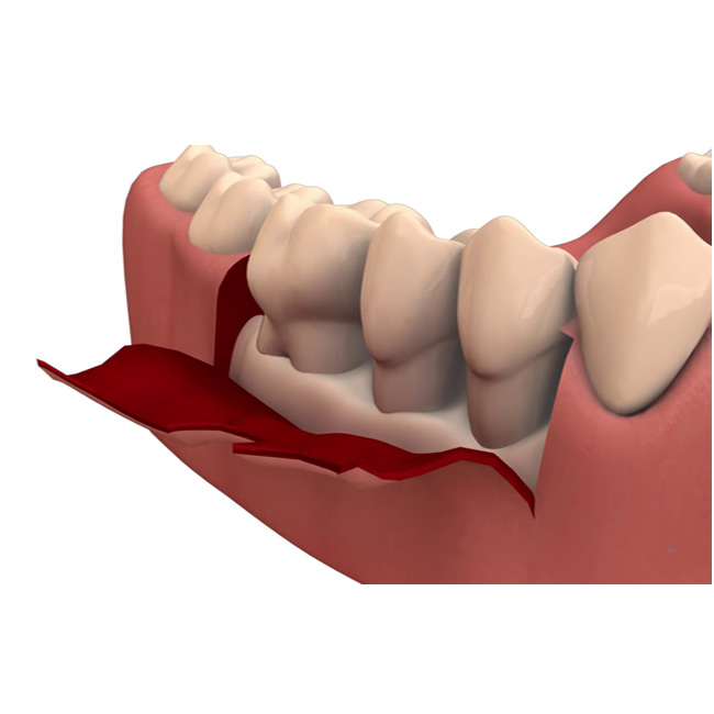 Periodontal Flap Surgery