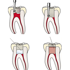 Pulpotomy 屈地街牙醫