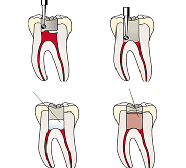 Pulpotomy