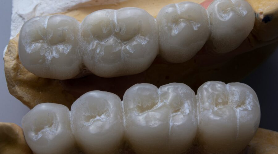Inlays and Onlays: A Conservative Way to Restore Damaged Teeth